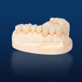 Customized Multilayered Zirconia for Dental Restoration